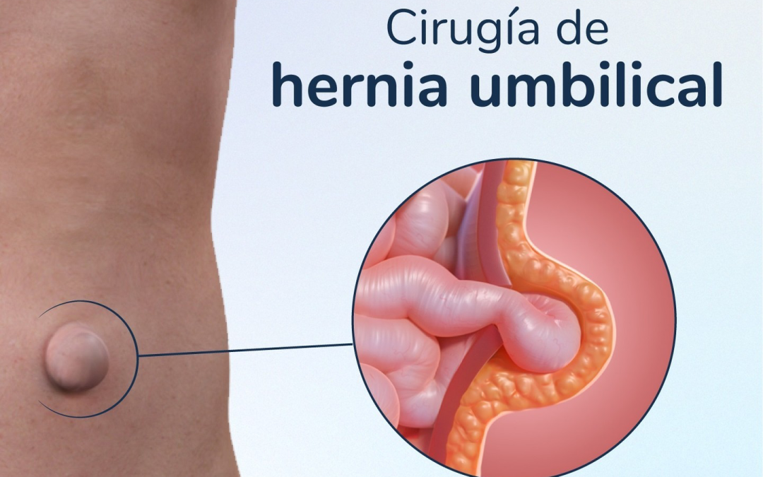 Hernia en el ombligo: ¿cuándo es necesario el tratamiento?