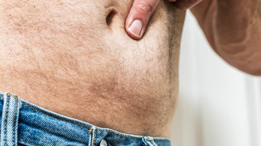 Hernia abdominal: causas y tratamiento